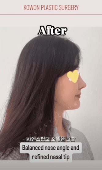 긴코수술은 어떻게 진행될까 — 처진코 원인 세 가지와 비중격·비주 조정, 회복 과정까지 관련 이미지 11/15