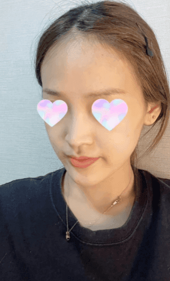 긴코수술은 어떻게 진행될까 — 처진코 원인 세 가지와 비중격·비주 조정, 회복 과정까지 관련 이미지 12/15