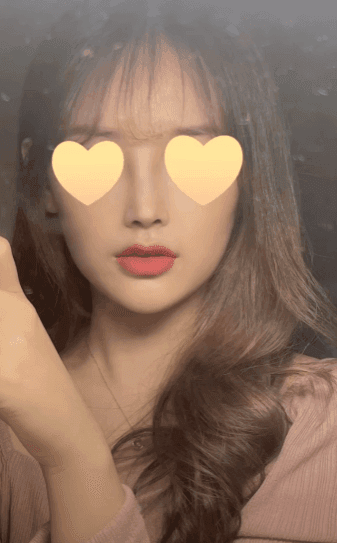 긴코수술은 어떻게 진행될까 — 처진코 원인 세 가지와 비중격·비주 조정, 회복 과정까지 관련 이미지 13/15