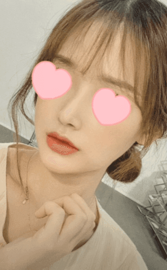 긴코수술은 어떻게 진행될까 — 처진코 원인 세 가지와 비중격·비주 조정, 회복 과정까지 관련 이미지 14/15