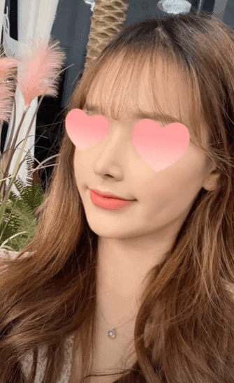 긴코수술은 어떻게 진행될까 — 처진코 원인 세 가지와 비중격·비주 조정, 회복 과정까지 관련 이미지 15/15