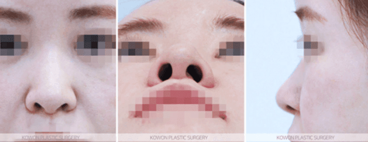긴코·퍼진코 재수술, 무엇부터 교정해야 할까 — 근육·절골·비율의 순서 (Q&A와 사례) 관련 이미지 4/10