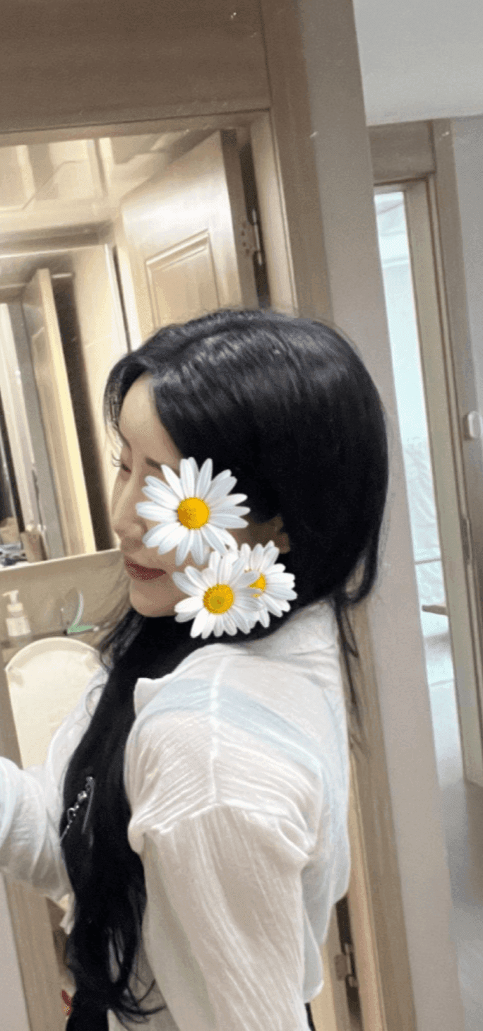 จมูกโหนกต่ำและสันกระดูกไม่เท่ากัน — กรณีที่แก้ไขความสูงและแนวของกระดูกโดยใช้กระดูกอ่อนซี่โครงของตนเองภาพที่เกี่ยวข้อง 1/23
