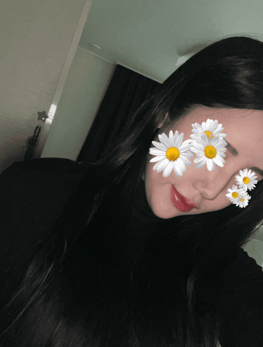 จมูกโหนกต่ำและสันจมูกไม่เรียบ — กรณีที่แก้ไขทั้งความสูงและแนวสันจมูกโดยใช้กระดูกอ่อนซี่โครงของตนเองภาพที่เกี่ยวข้อง 4/23