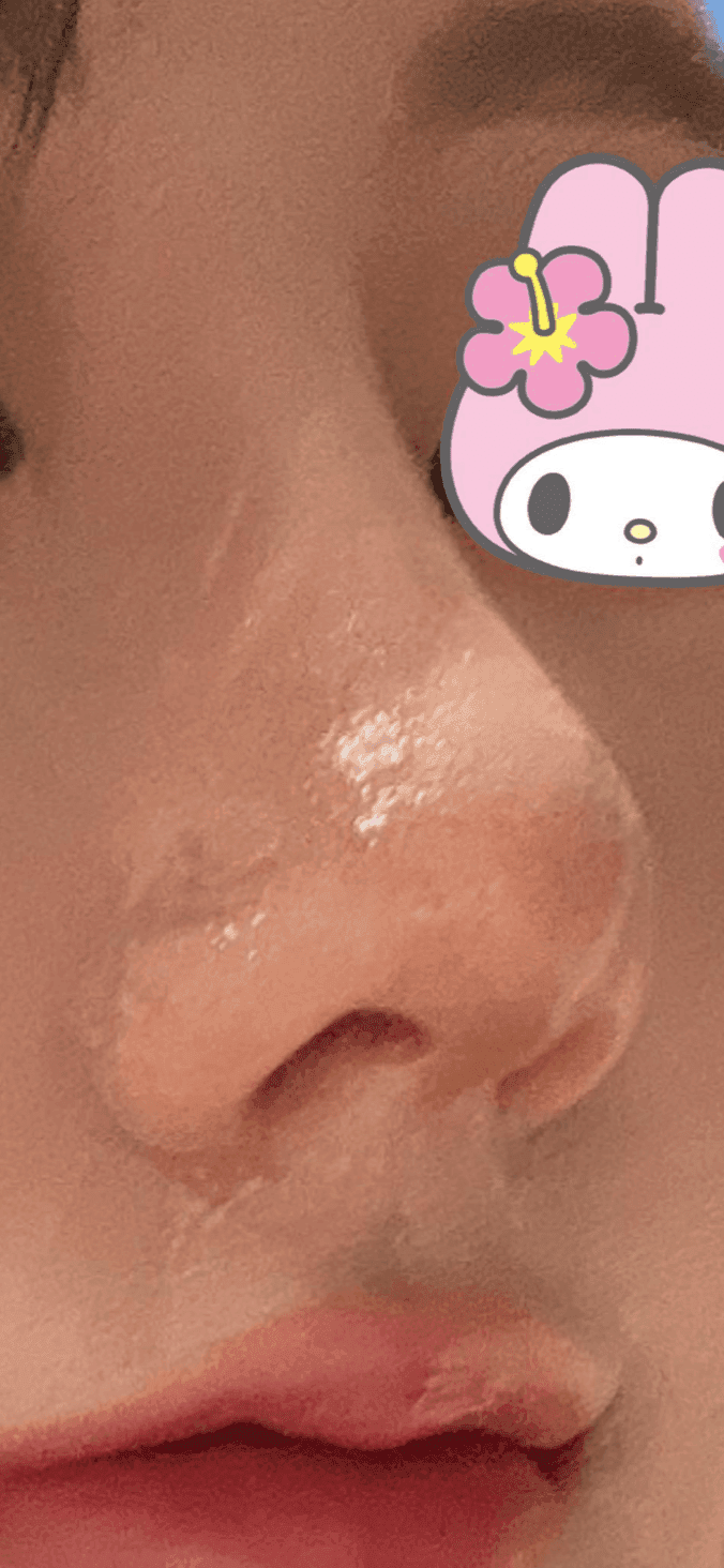 จมูกโหนกต่ำและสันจมูกไม่เรียบ — ภาพประกอบจากกรณีที่ทำการแก้ไขทั้งความสูงและแนวสันจมูกโดยใช้กระดูกอ่อนซี่โครงของตนเอง 7/23