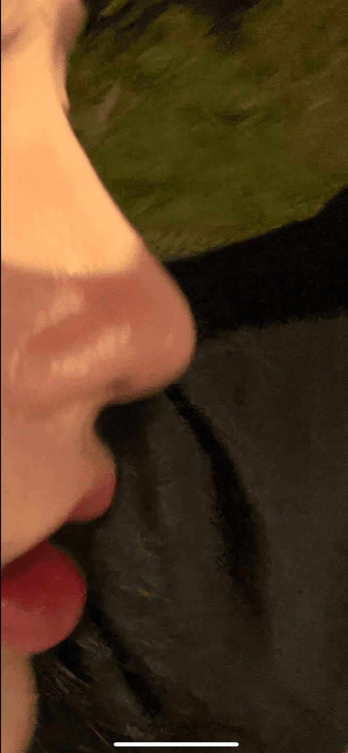 낮은데 콧등이 울퉁불퉁한 매부리코 — 자가늑연골로 높이와 라인을 함께 잡은 사례 관련 이미지 9/23