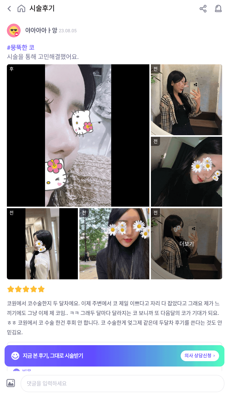 จมูกโหนกต่ำและสันจมูกไม่เรียบ — กรณีที่แก้ไขทั้งความสูงและแนวสันจมูกโดยใช้กระดูกอ่อนซี่โครงของตนเองภาพที่เกี่ยวข้อง 10/23