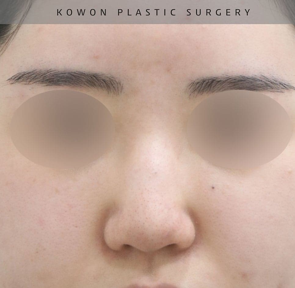 낮은데 콧등이 울퉁불퉁한 매부리코 — 자가늑연골로 높이와 라인을 함께 잡은 사례 관련 이미지 12/23
