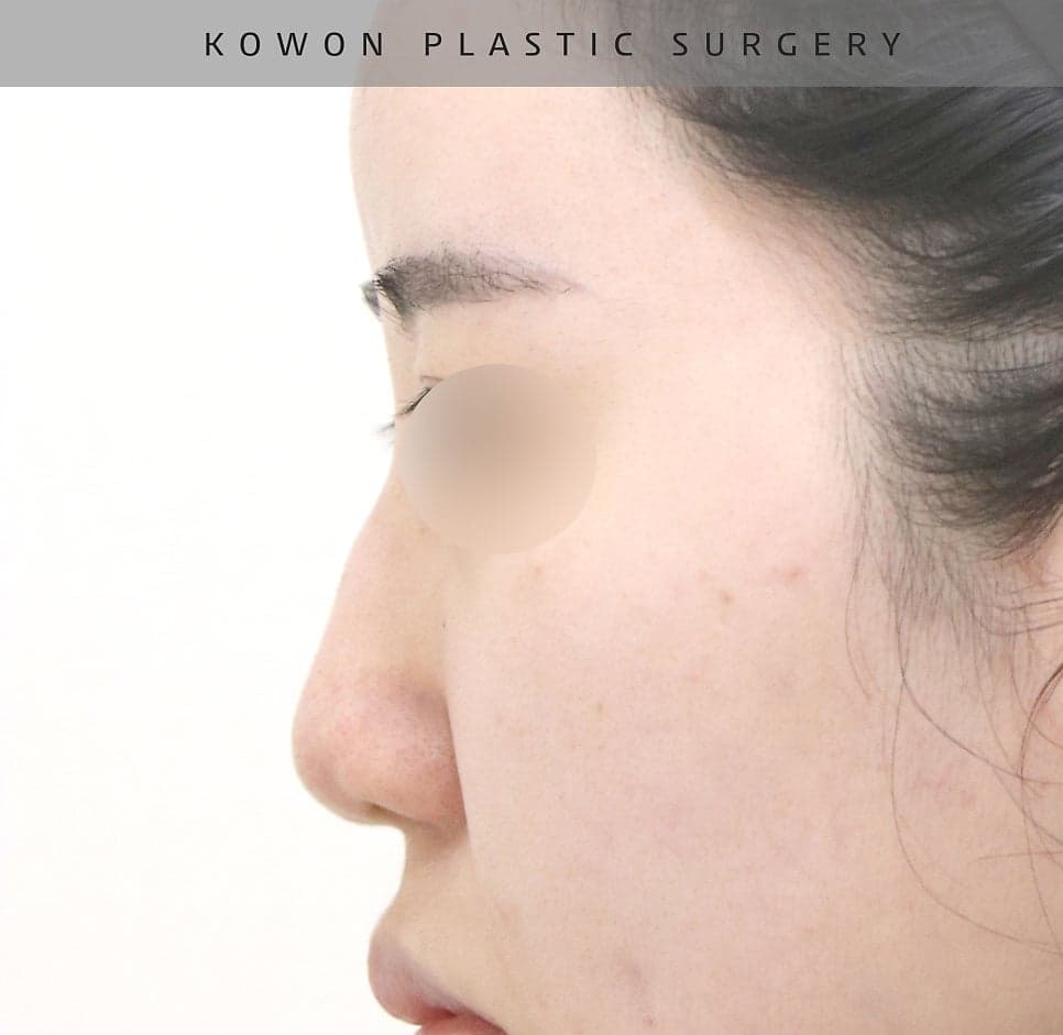 낮은데 콧등이 울퉁불퉁한 매부리코 — 자가늑연골로 높이와 라인을 함께 잡은 사례 관련 이미지 13/23