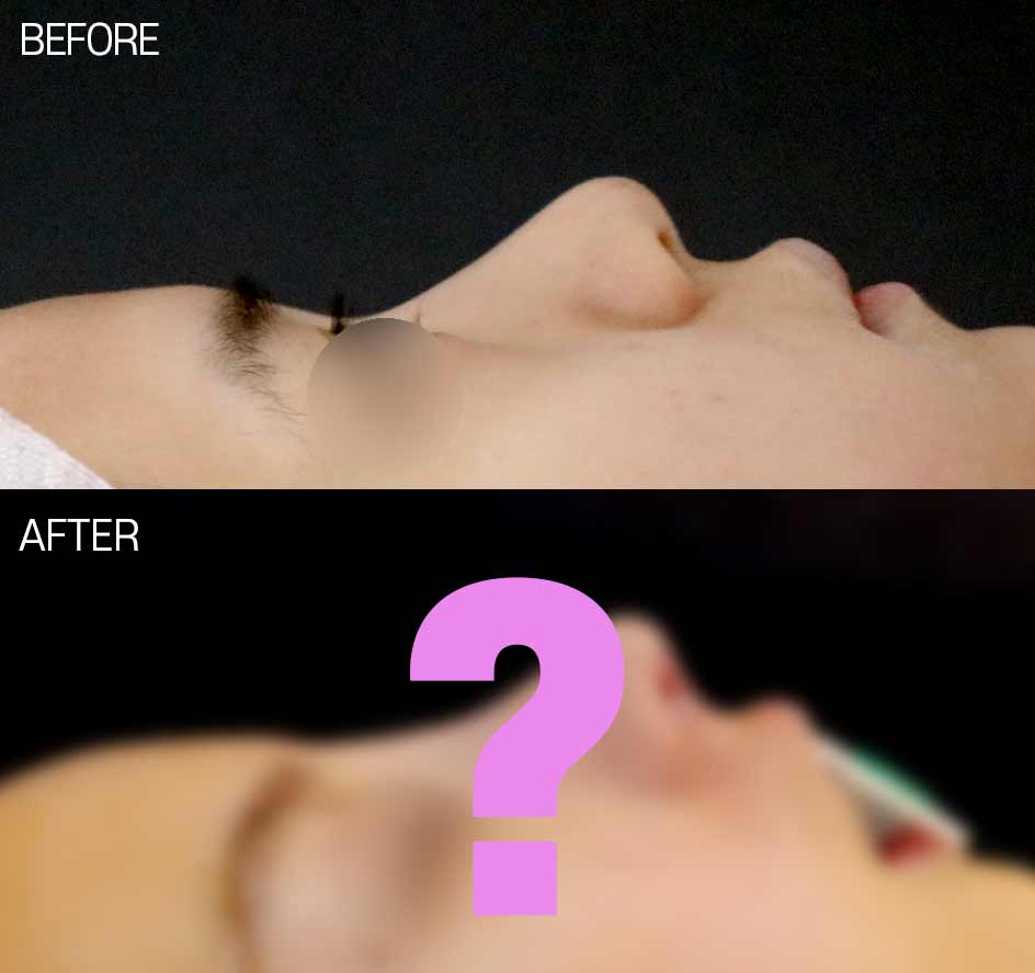 낮은코 성형, 비중격만곡증 교정까지 함께 할 수 있나요 — 보형물 선택과 코입각을 보는 기준 관련 이미지 2/4