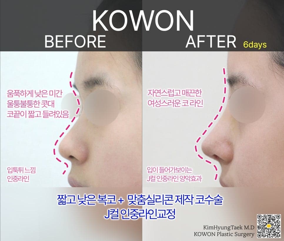 낮은코 성형, 비중격만곡증 교정까지 함께 할 수 있나요 — 보형물 선택과 코입각을 보는 기준 관련 이미지 4/4