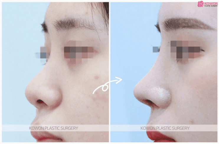 낮은코수술, 미간이 낮으면 왜 콧대만 세워서는 안 될까 — 시작점과 라인 연결 관련 이미지 3/6
