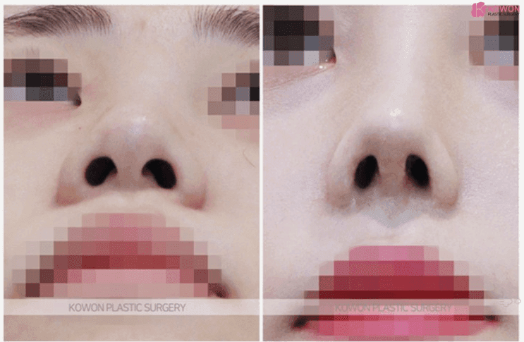 낮은코수술, 미간이 낮으면 왜 콧대만 세워서는 안 될까 — 시작점과 라인 연결 관련 이미지 4/6