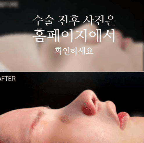 낮은코성형, 코끝부터 비순각까지 함께 봐야 하는 세 가지 이유 관련 이미지 2/11