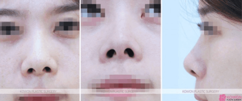 낮은코성형, 코끝부터 비순각까지 함께 봐야 하는 세 가지 이유 관련 이미지 5/11