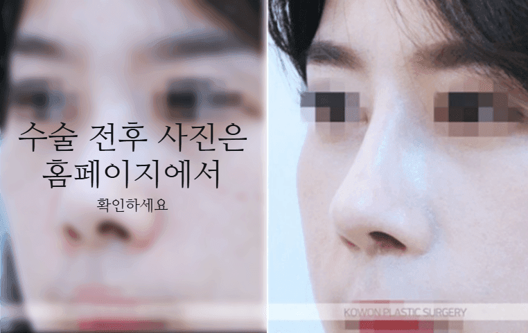 낮은코성형, 코끝부터 비순각까지 함께 봐야 하는 세 가지 이유 관련 이미지 7/11