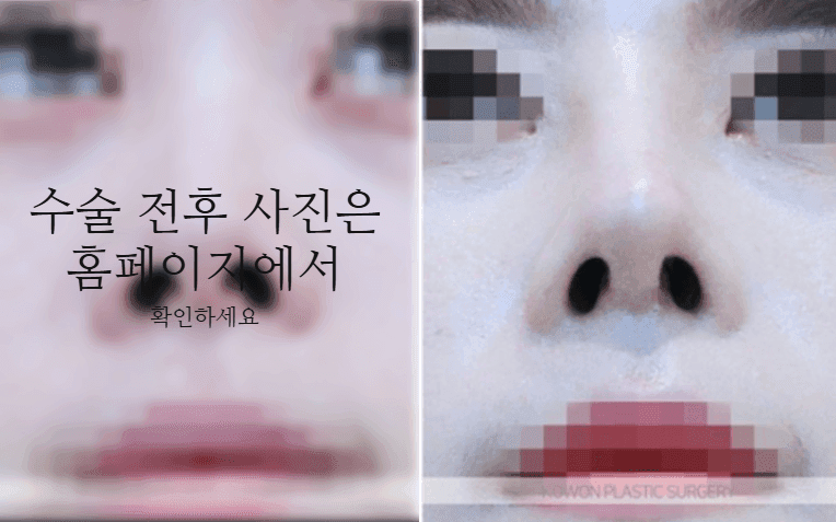 낮은코성형, 코끝부터 비순각까지 함께 봐야 하는 세 가지 이유 관련 이미지 8/11