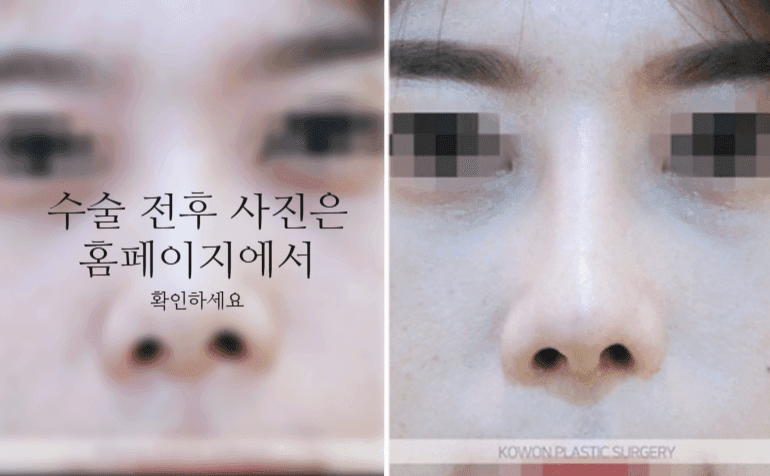 낮은코성형, 코끝부터 비순각까지 함께 봐야 하는 세 가지 이유 관련 이미지 9/11