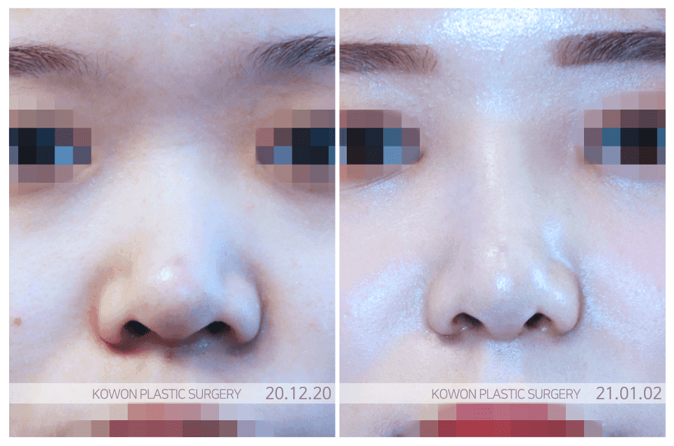 낮은코성형, 높이보다 조화 — 자연스러운 입체감을 결정하는 확인 순서 관련 이미지 7/7