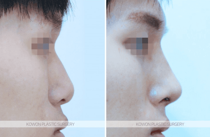 낮은코 수술 10일째, 코가 너무 부각돼 실리콘을 빼고 싶을 때 — 붓기와 판단 시점 관련 이미지 4/5