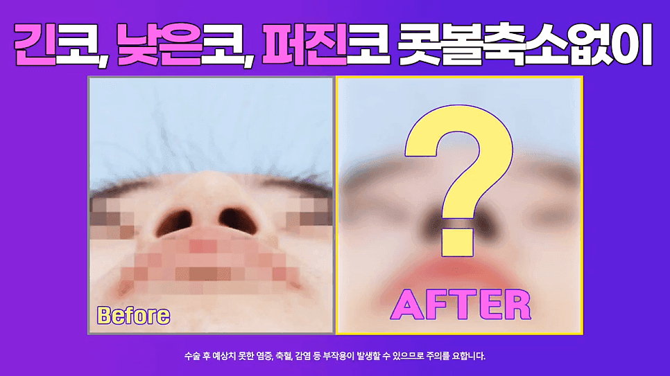 낮은코 교정 사례 — 콧볼 축소 없이 코끝교정·코끝내림근 교정으로 퍼진코까지 개선한 경우 관련 이미지 1/8