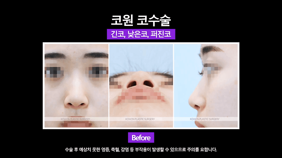 낮은코 교정 사례 — 콧볼 축소 없이 코끝교정·코끝내림근 교정으로 퍼진코까지 개선한 경우 관련 이미지 4/8