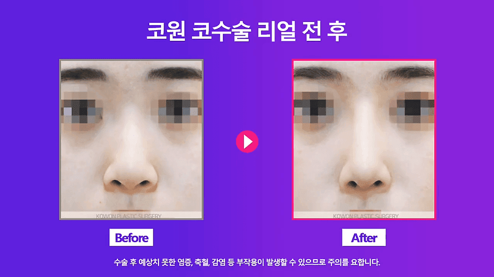 낮은코 교정 사례 — 콧볼 축소 없이 코끝교정·코끝내림근 교정으로 퍼진코까지 개선한 경우 관련 이미지 5/8