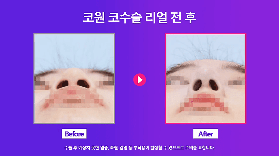 낮은코 교정 사례 — 콧볼 축소 없이 코끝교정·코끝내림근 교정으로 퍼진코까지 개선한 경우 관련 이미지 6/8