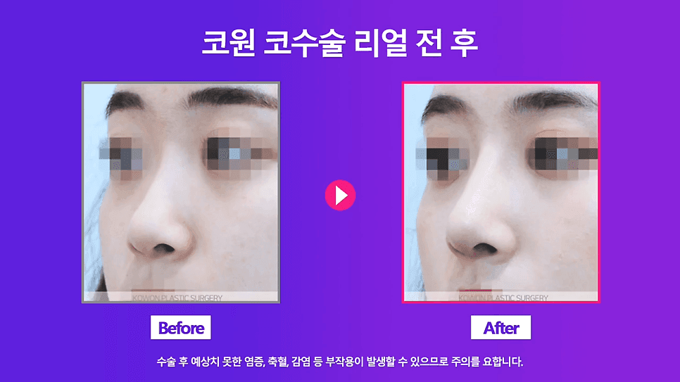 낮은코 교정 사례 — 콧볼 축소 없이 코끝교정·코끝내림근 교정으로 퍼진코까지 개선한 경우 관련 이미지 7/8