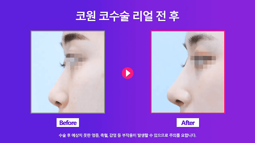 낮은코 교정 사례 — 콧볼 축소 없이 코끝교정·코끝내림근 교정으로 퍼진코까지 개선한 경우 관련 이미지 8/8
