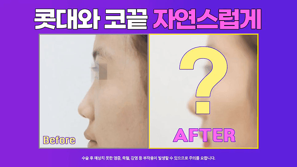 낮은코성형 사례 — 코끝올리기로 퍼진코까지 함께 교정한 이유 관련 이미지 1/8