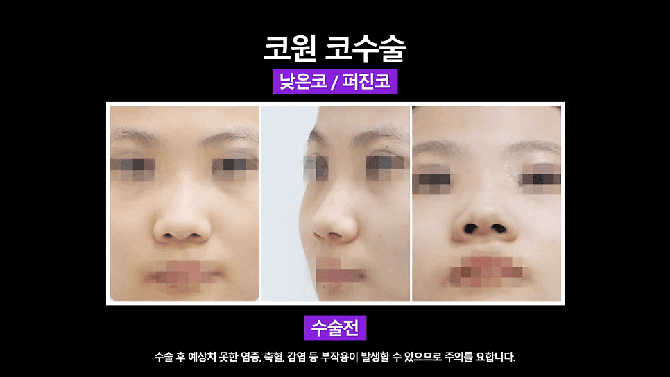 낮은코성형 사례 — 코끝올리기로 퍼진코까지 함께 교정한 이유 관련 이미지 4/8