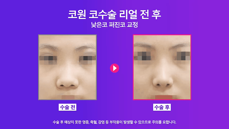 กรณีการแก้ไขจมูกต่ำ— เหตุใดจึงต้องแก้ไขจมูกกว้างควบคู่กับการยกปลายปลายจมูกภาพประกอบที่เกี่ยวข้อง 5/8
