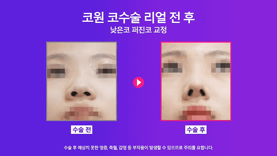 낮은코성형 사례 — 코끝올리기로 퍼진코까지 함께 교정한 이유 관련 이미지 6/8