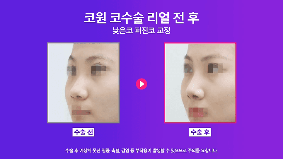 낮은코성형 사례 — 코끝올리기로 퍼진코까지 함께 교정한 이유 관련 이미지 7/8