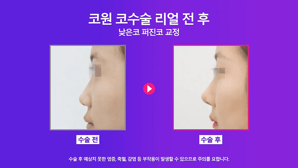 낮은코성형 사례 — 코끝올리기로 퍼진코까지 함께 교정한 이유 관련 이미지 8/8