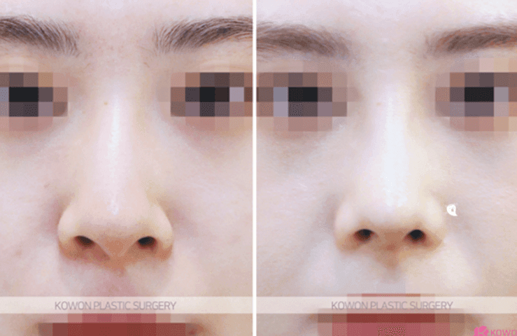 낮은코성형, 콧대 높이만으로 입체감이 살아날까 — 코끝연골재배치와 중안면부 균형 사례 관련 이미지 4/11