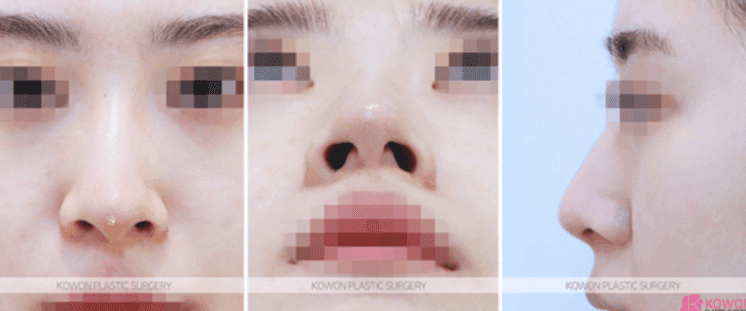 낮은코성형, 콧대 높이만으로 입체감이 살아날까 — 코끝연골재배치와 중안면부 균형 사례 관련 이미지 5/11