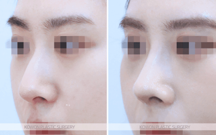 낮은코성형, 콧대 높이만으로 입체감이 살아날까 — 코끝연골재배치와 중안면부 균형 사례 관련 이미지 7/11