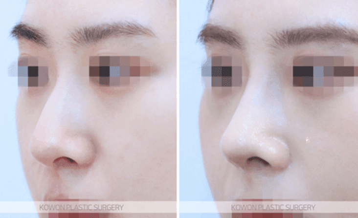 낮은코성형, 콧대 높이만으로 입체감이 살아날까 — 코끝연골재배치와 중안면부 균형 사례 관련 이미지 8/11