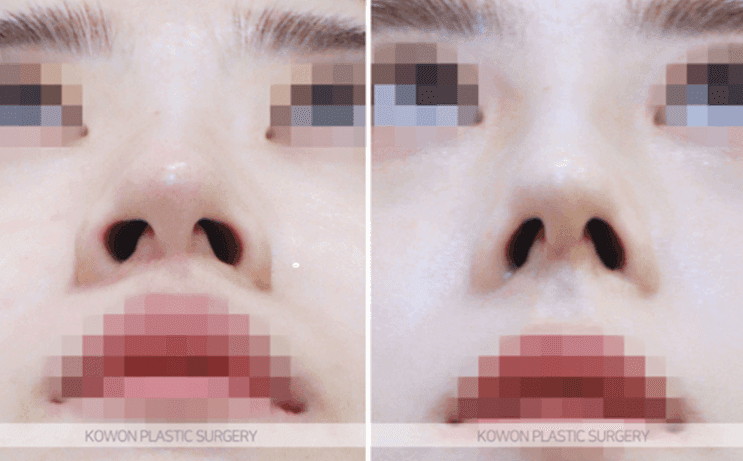 낮은코성형, 콧대 높이만으로 입체감이 살아날까 — 코끝연골재배치와 중안면부 균형 사례 관련 이미지 10/11