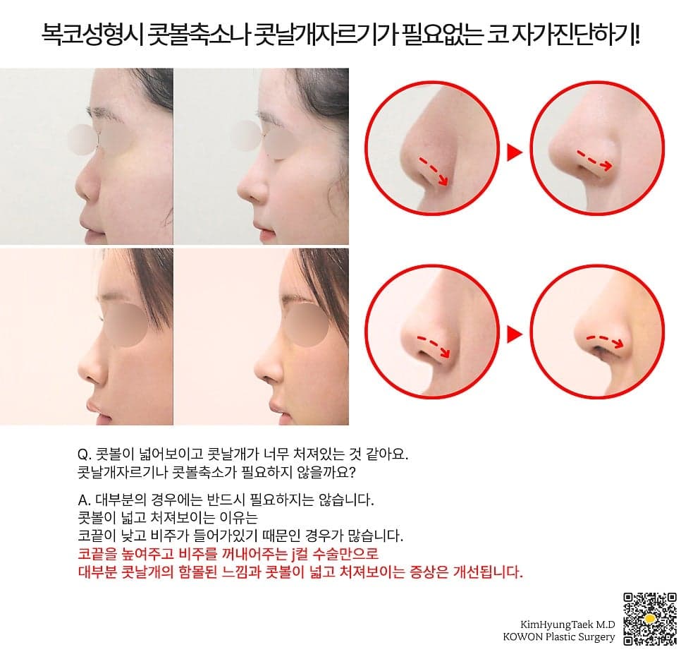 남자 콧볼축소, 절개선과 흉터가 걱정된다면 — 대상과 수술 방법 정리 관련 이미지 2/8