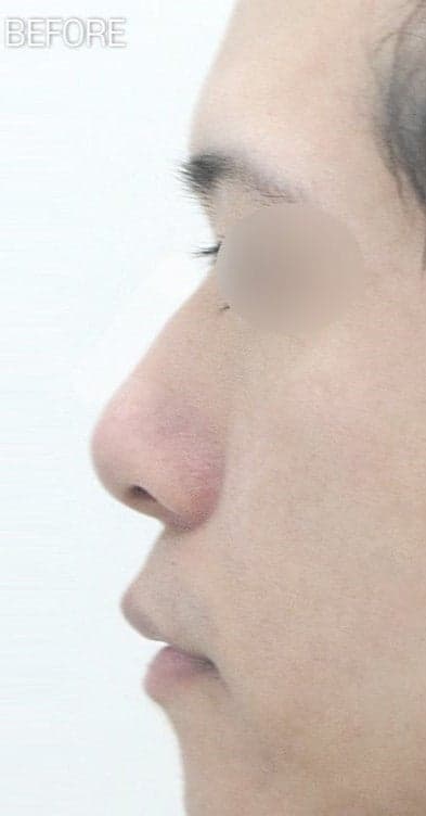남자 콧볼축소, 절개선과 흉터가 걱정된다면 — 대상과 수술 방법 정리 관련 이미지 7/8
