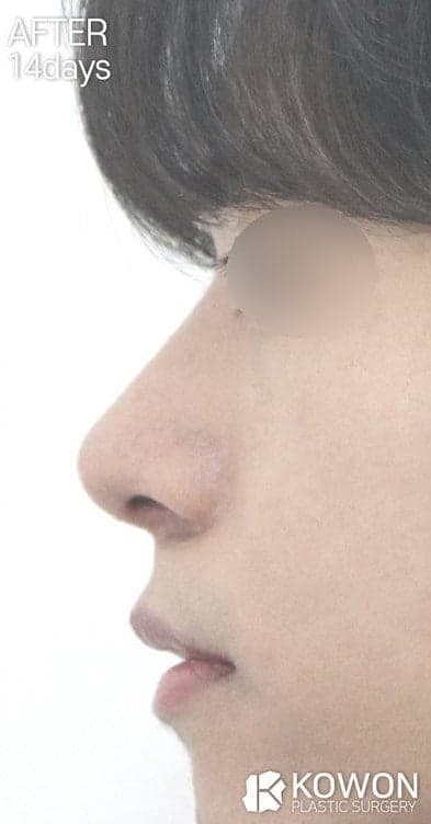 남자 콧볼축소, 절개선과 흉터가 걱정된다면 — 대상과 수술 방법 정리 관련 이미지 8/8