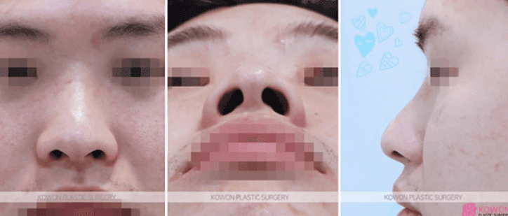 콧대뼈 절골과 코끝성형으로 큰 코 개선이 가능할까요? — 남자 코수술 질문 관련 이미지 3/9