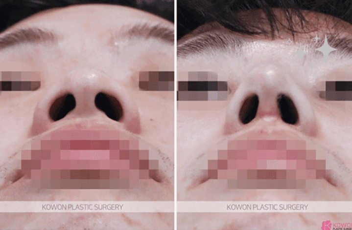 콧대뼈 절골과 코끝성형으로 큰 코 개선이 가능할까요? — 남자 코수술 질문 관련 이미지 5/9