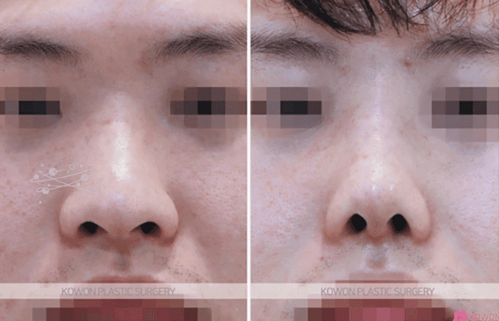 콧대뼈 절골과 코끝성형으로 큰 코 개선이 가능할까요? — 남자 코수술 질문 관련 이미지 7/9