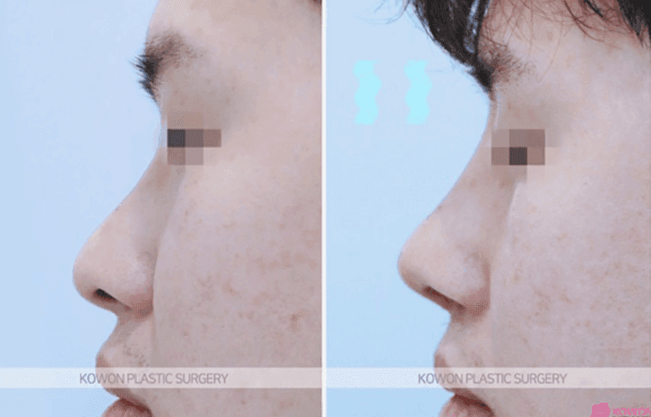 콧대뼈 절골과 코끝성형으로 큰 코 개선이 가능할까요? — 남자 코수술 질문 관련 이미지 8/9