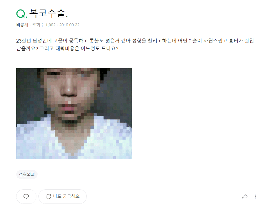 남자 콧볼축소수술과 복코수술 전후 — 지식iN 질문과 비절개 교정 사례로 본 기준 관련 이미지 2/10