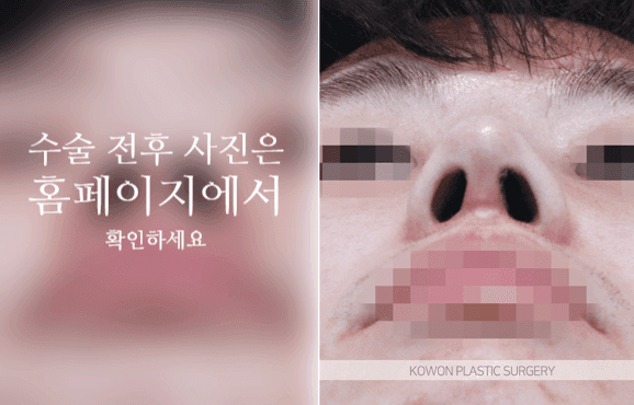 การผ่าตัดปลายจมูกกลมใหญ่ในผู้ชาย: เหตุใดจึงต้องพิจารณาส่วนนูนและปีกจมูกไปพร้อมกัน — ภาพประกอบที่เกี่ยวข้องกับความสมดุลของปลายจมูก สันจมูกและปีกจมูก 4/10
